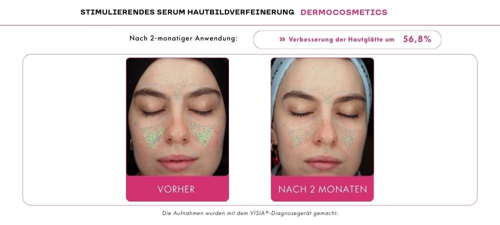 adapinoid Verbesserung der Hautglätte