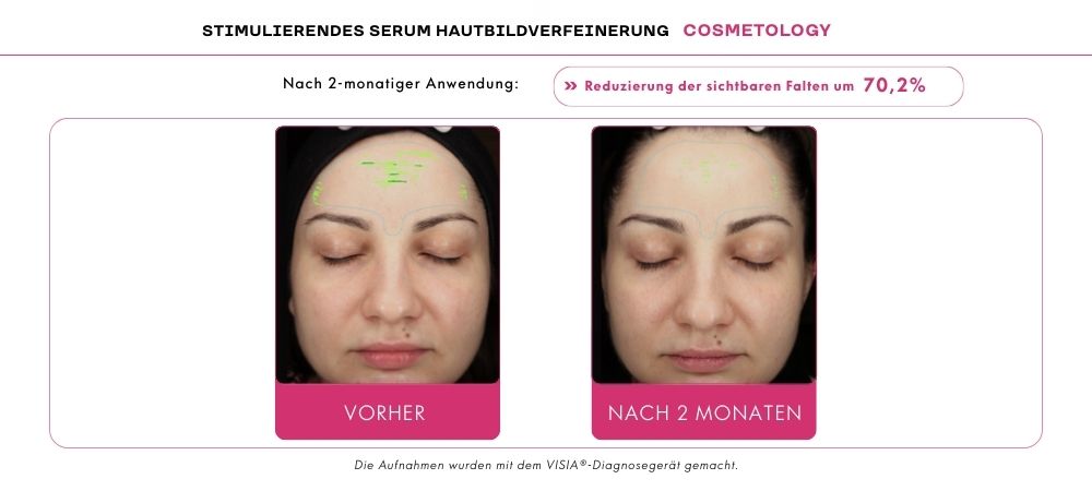 adapinoid Reduzierung der sichtbaren Falten