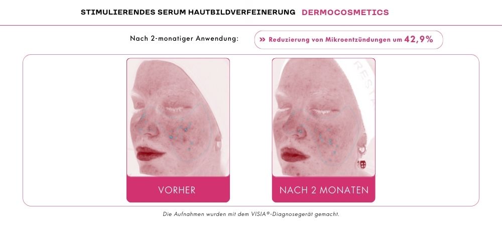 Reduzierung von Mikroentzündungen adapinoid