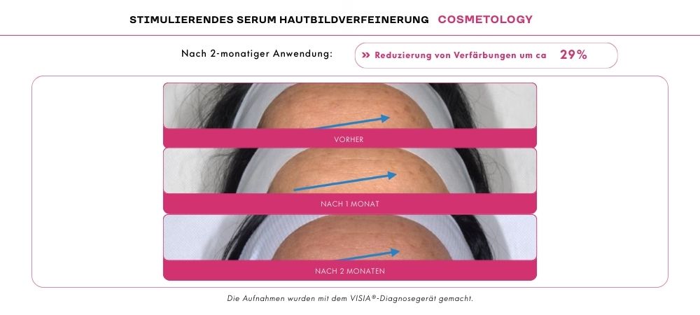 adapinoid Reduzierung von Verfärbungen